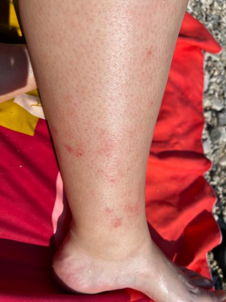 Sme na dovolenke a na nohe sa mi urobili červené fľaky