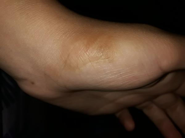 Na ľavej dlani pri palci mám hnedý fľak. O aký problém ide?