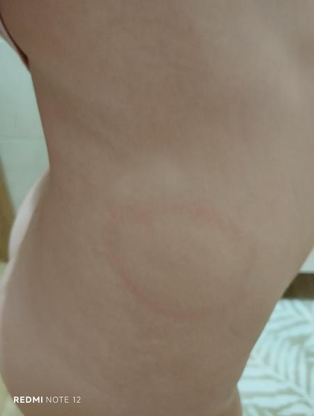 Aké sú príčiny fľakov na koži dieťaťa?