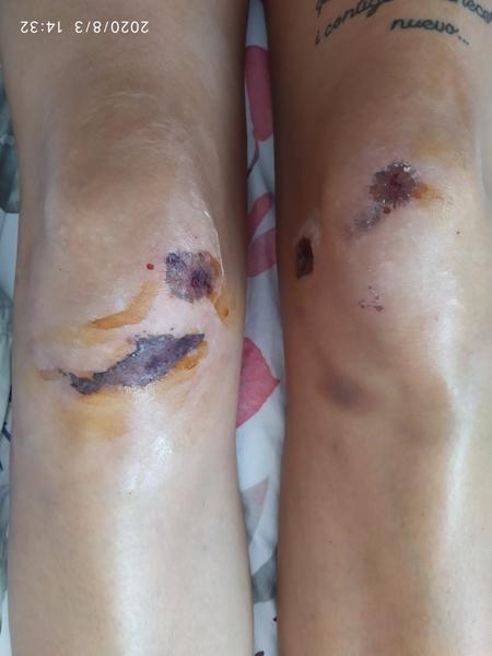 Ako očistiť rozbité kolená?