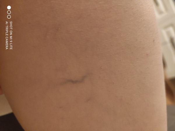 Už 4 roky má kŕčové žily