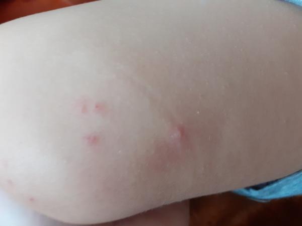 Čo pomôže proti štípancom?