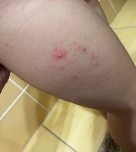 Ako vyriešiť vyrážky u 3-ročného dieťaťa?