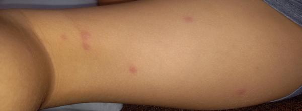 Sú tieto štípance od ploštíc?