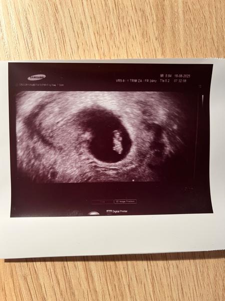 Kde je žĺtkový vak na ultrazvukovom snímku?