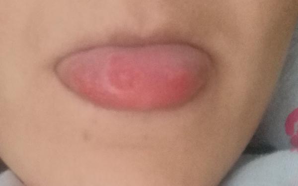 Fľaky na jazyku v tehotenstve