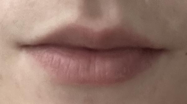 Zväčšili by ste si jemne pery?