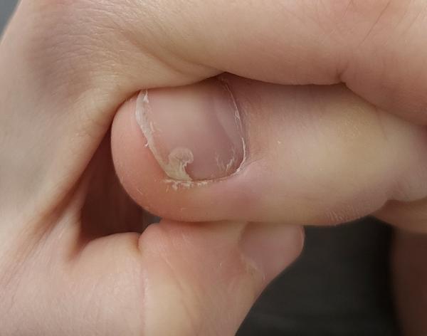 Máte skúsenosť s problémom s nechtom?