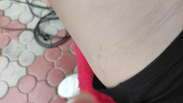 Čo znamenajú tieto červené žilky na spodnej strane stehna?