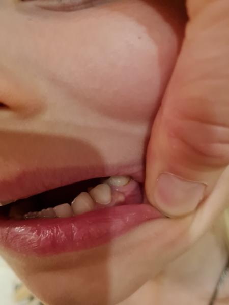 Z čoho môže mať dcérka na vačok na ďasne?