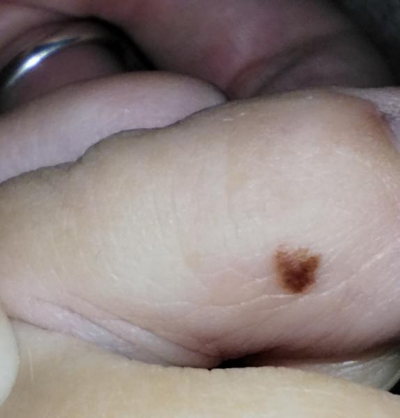 Podozrivé znamienko