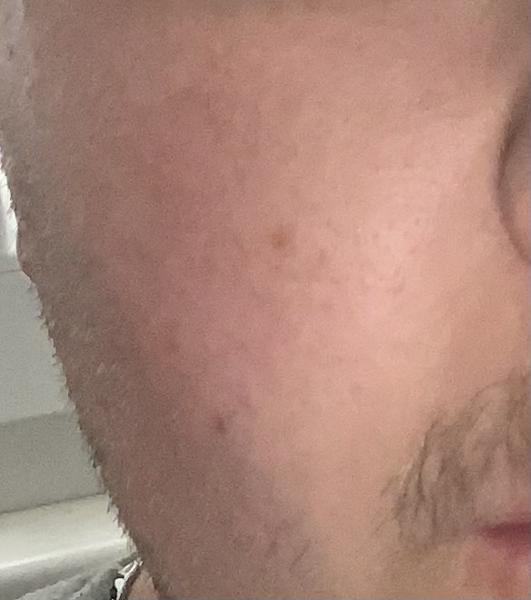 Domáce recepty na zmiernenie začervenanej tváre