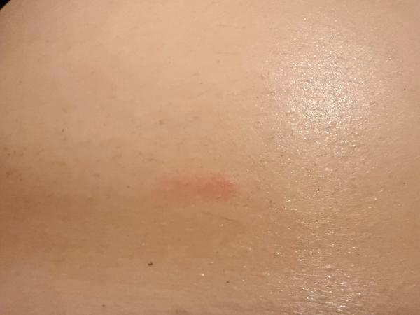 Môže to byť svrab?