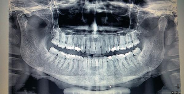 Vysvetlíte mi RTG snímok zubov?