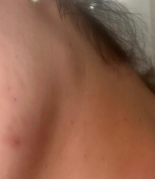 Je zväčšená uzlina pod sánkou po chorobe normálna?