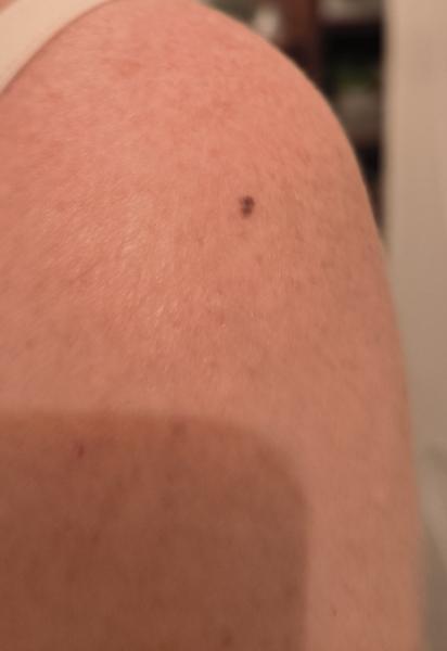 Ako zvládnuť strach z podozrivého znamienka?