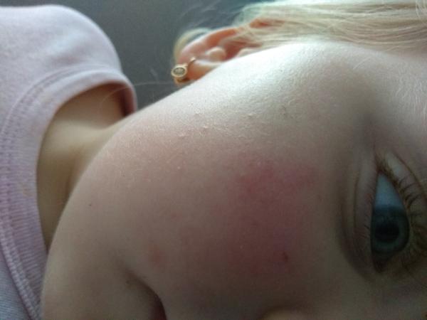 Vyrážky - podkožný tuk, "krupica"