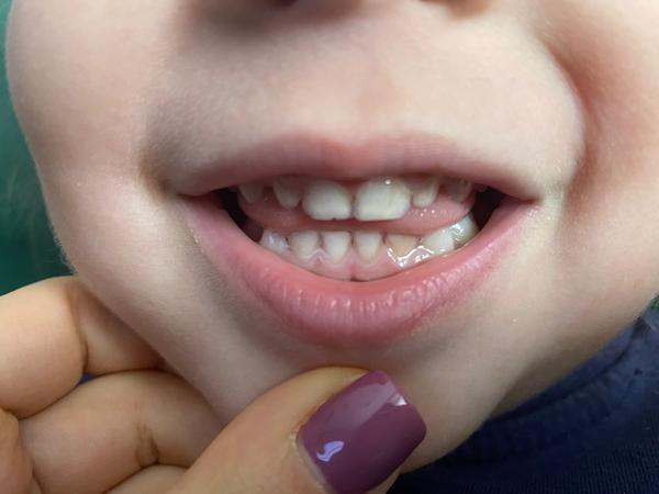 Ako pomôcť štvorročnej dcérke, ktorá má povlak na zuboch?