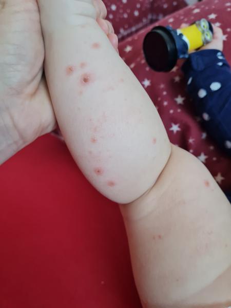 Je to siedma choroba alebo kiahne?