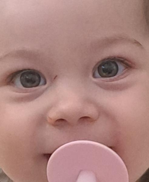 Pomoc s poruchou zraku u 18-mesačného dieťaťa