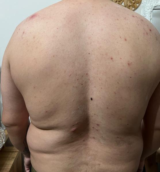 Čo pomôže na vredy na chrbte?