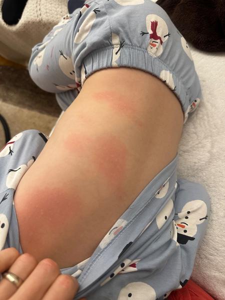 Záhadná vyrážka u trojročnej dcéry