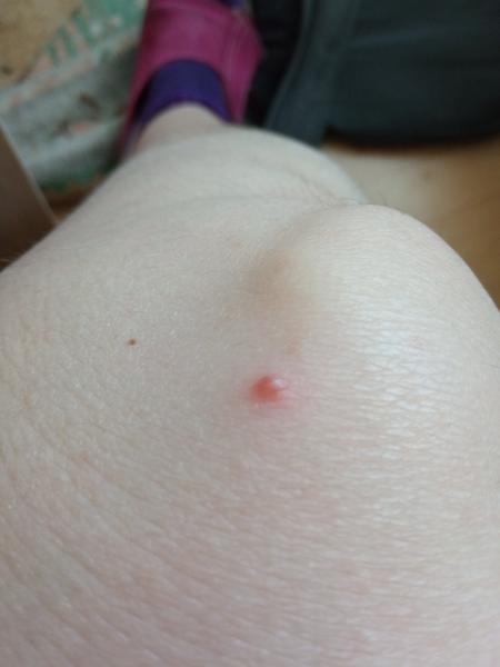 Mám boľavé znamienko