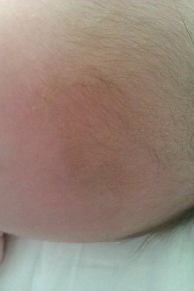 Žlté fliačiky na hlave