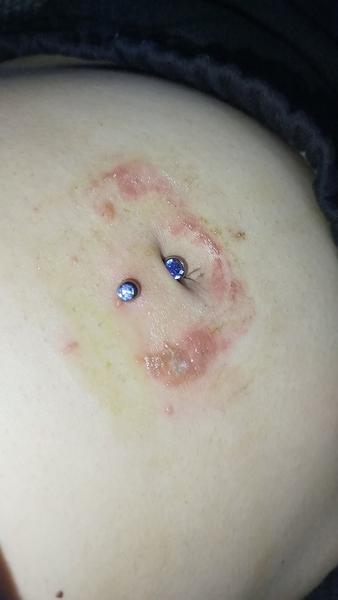 Červené škvrny pri piercingu: Ako ich riešiť?