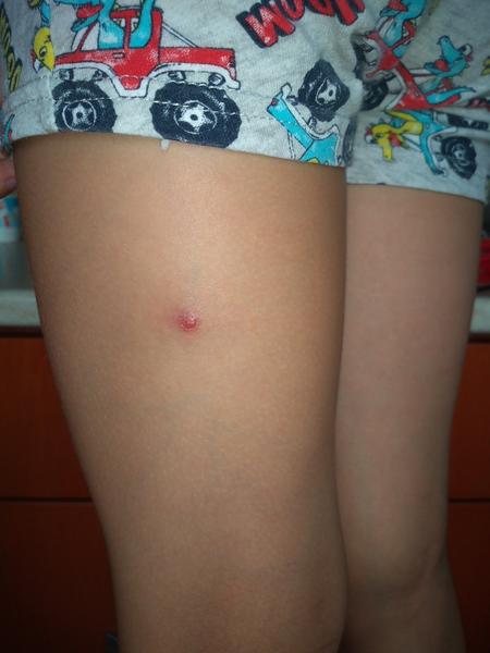 Má moje dieťa molusky?