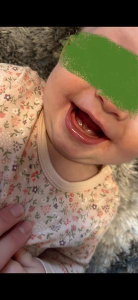 Sú to prvé zúbky u 9-mesačného dieťaťa?