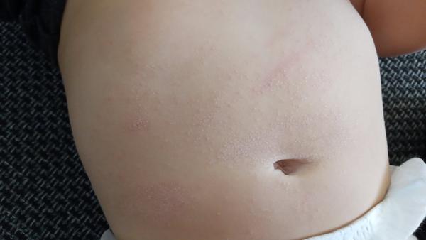 Ročný syn má už 2 týždne fľaky po rukách a na bruchu