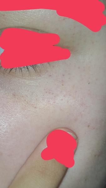 Čo spôsobuje červeno-hnedé bodky pod očami?