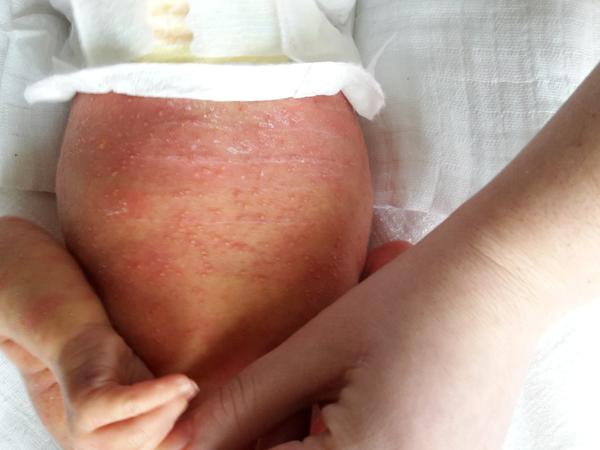 Biele pľuzgieriky u novorodenca