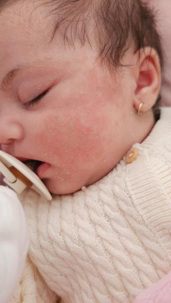 Červené a suché líčka u sedem týždňového bábätka, môže ísť o ekzém?