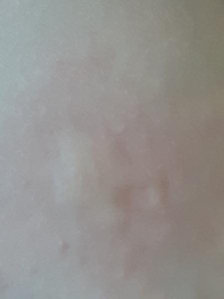 Čo je to za divnú vyrážku?