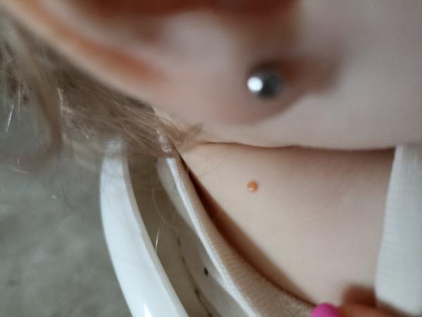 Čo môže byť príčinou vyrážky u dieťaťa?