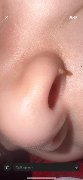 Výrastok na nose u päťročného syna