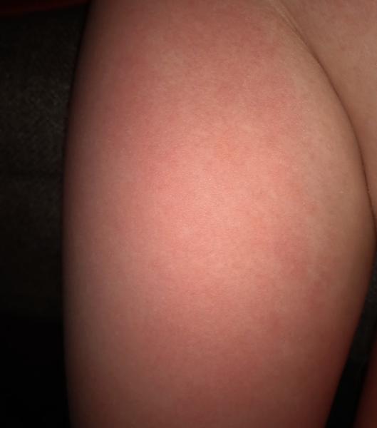 Červené fľaky u dieťaťa