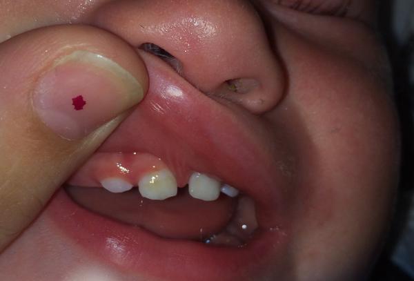 Hnedý povlak na mliečnom zube