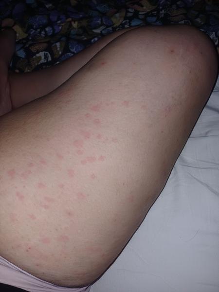 Aký mám kožný problém s pálením?