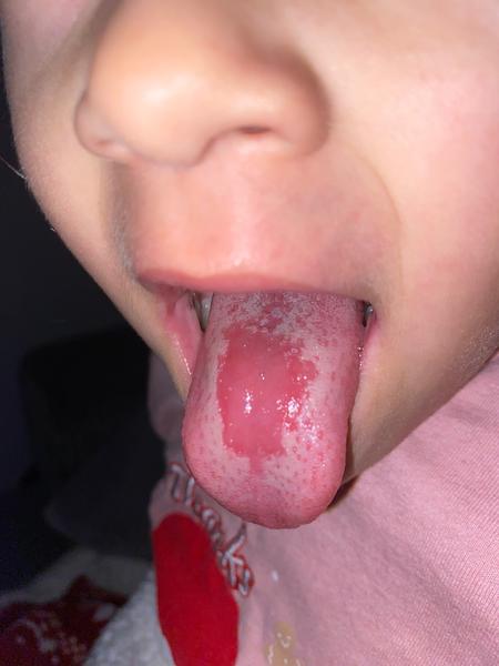 Môže byť fľakatý jazyk následkom antibiotík?