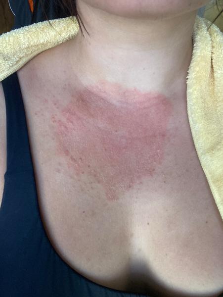 Identifikácia svrbiacej vyrážky na hrudi