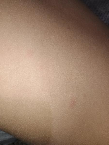 Sú to kiahne alebo nie? Ako postupovať?