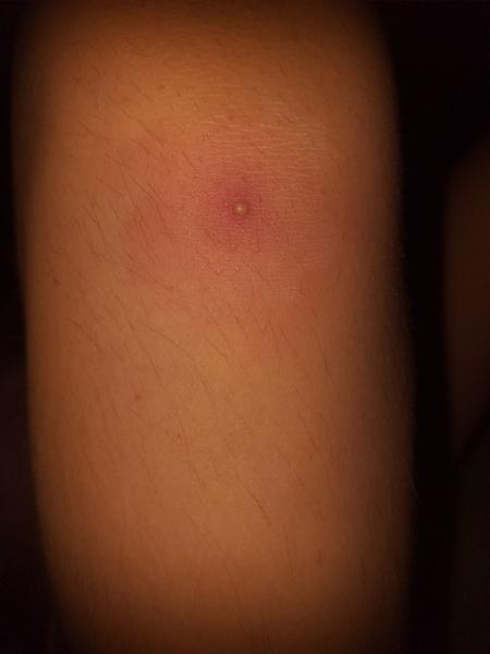 Akú vyrážku pod kolenom má moja dcérka?