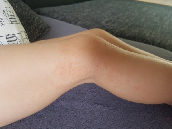 Poznáte takýto ekzém?