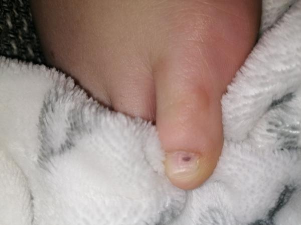 Mám pod nechtom znamienko?