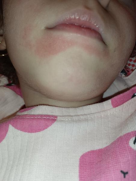 Začervenanie pod perou