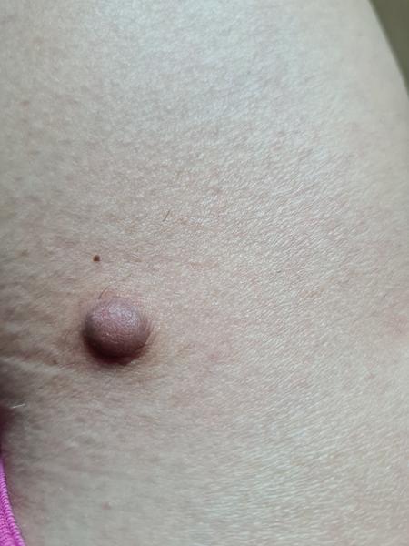 Vzniklo mi znamienko na nohe. Ako ho liečiť?