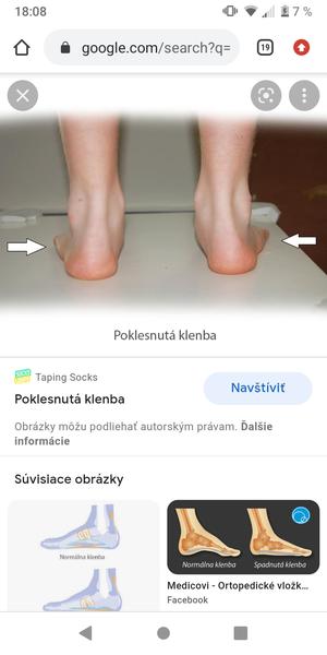 Čo vám pomohlo na padnutú klenbu?